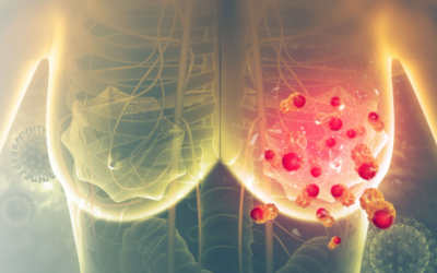 How Fast Does Breast Cancer Spread?