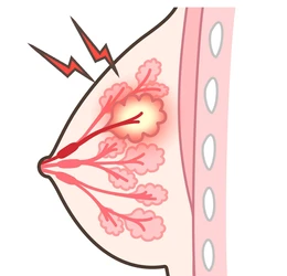 Cross-sectional illustration of a breast showing lobules and ducts, with a red glow indicating inflammation or pain in the inner tissue.