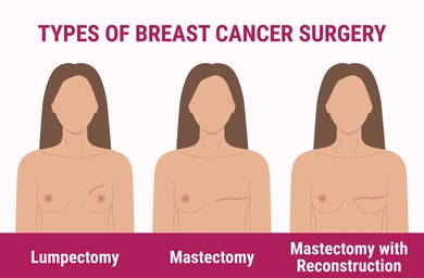 Illustration of three female torsos labeled Lumpectomy, Mastectomy, and Mastectomy with Reconstruction, showing breast cancer surgery options.