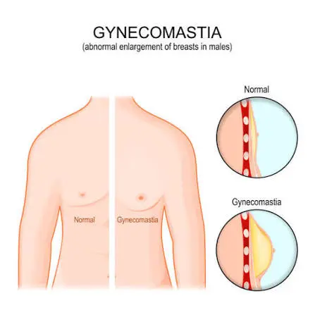 Diagram comparing male chests: left normal, right showing gynecomastia, with circular tissue insets on the right side.