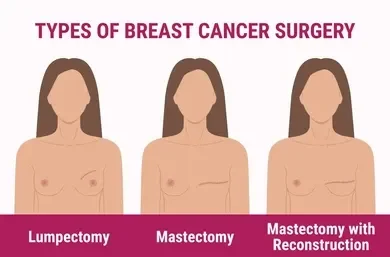 Illustration of three female silhouettes representing breast cancer surgery options: lumpectomy, mastectomy, and mastectomy with reconstruction.