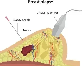 Cross-sectional diagram of a breast showing a biopsy needle targeting a tumor with an ultrasound probe nearby and labeled vessels and tissue.