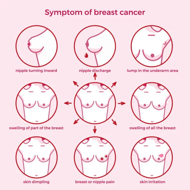 Breast cancer (4) Nipple turning inward in a breast diagram (informational) on pink infographic surface? No, keep concise: Nipple turning inward in a breast diagram.