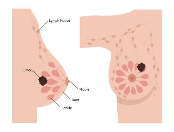 Medical diagram of breast tissue showing a tumor in the left breast and labeled ducts, lobules, nipple, and lymph nodes.