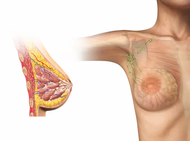 Anatomical diagram of breast tissue showing internal structures and a highlighted tumor in the right breast.