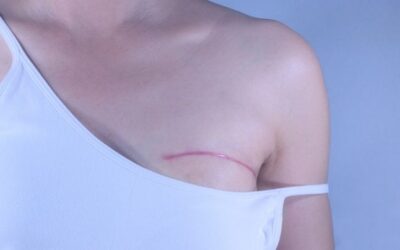 What Happens After Breast Cancer Surgery?