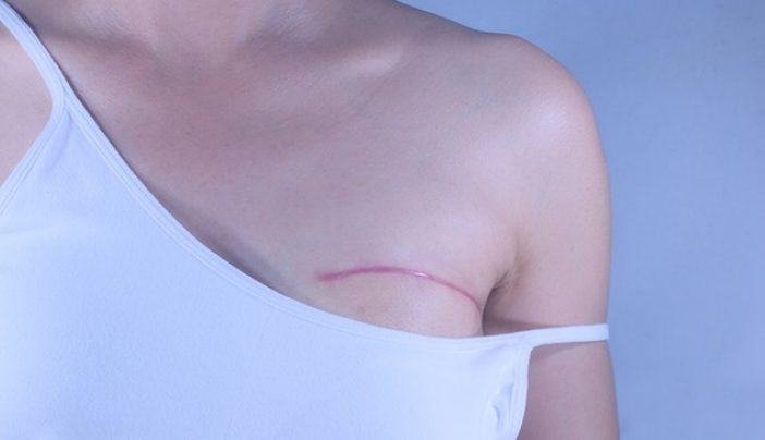 What Happens After Breast Cancer Surgery